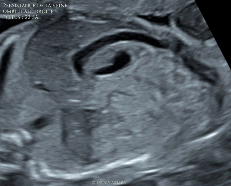 Persistance de la veine ombilicale droite : fœtus de 22 SA