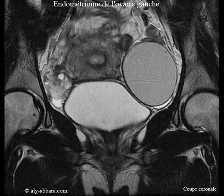 Endométriome de l'ovaire gauche - L'aspect à l'IRM