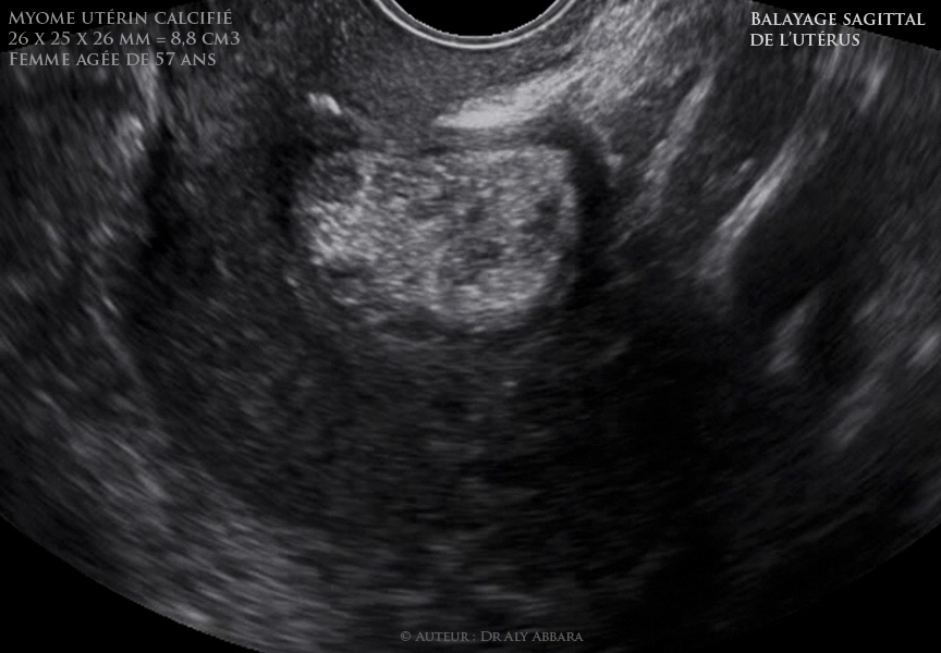 Utérus :  myome intra-mural antérieur calcifié chez une patiente âgée de 57 ans