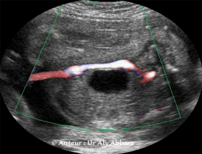 Images échographiqiues mettant en évidence la présence d'une artère ombilicale unique à comparer à la présence des deux artères ombilicales