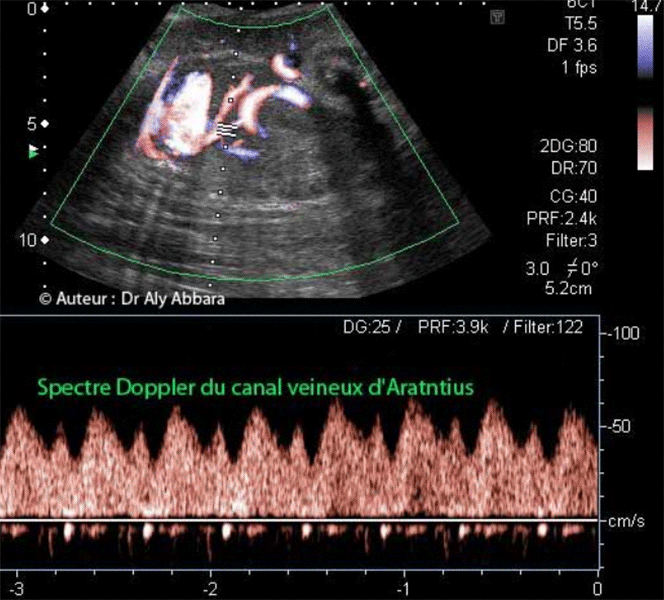 Canal veineux -Doppler -Spectre spécifique comparé au spectre des veines sus-hépatiques et de la veine ombilicale