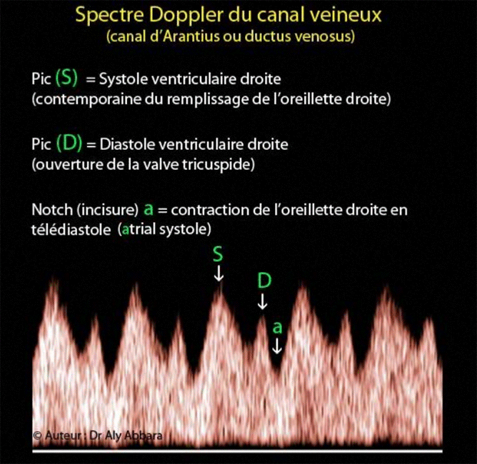 Spectre Doppler du canal veineux foetal