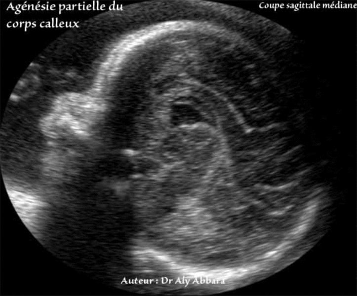 Agénésie partielle du corps calleux - foetus de 30 SA - Bec, genou et splenum sont manquants