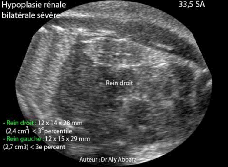 Hypoplasie rénale bilatérale foetale à 33,5 SA - Coupe échographie AP
