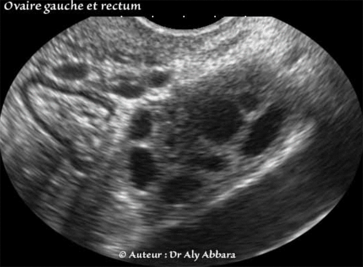 Anatomie échographique - Ovaire gauche au voisinage du rectum
