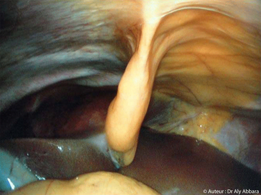 Aspect anatomique coelioscopique de la région périhépatique normale