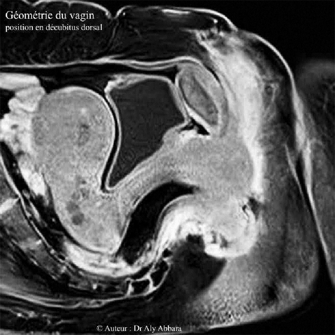 Vagin de femme adulte - L'arc anatomique - IRM