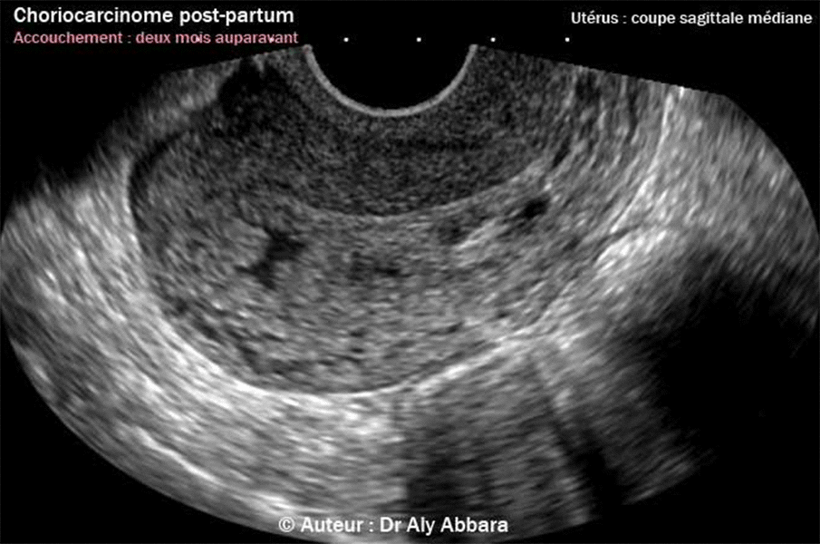 Choriocarcinome survenant en post-partum après un accouchement normal 2 mois auparavant