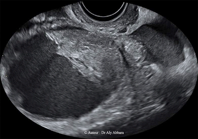 Grossesse extra-utérine tubaire gauche - future grossesse gémellaire - J1