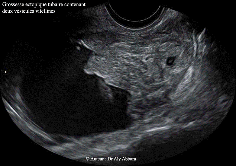 Grossesse extra-utérine tubaire gauche - future grossesse gémellaire - J2