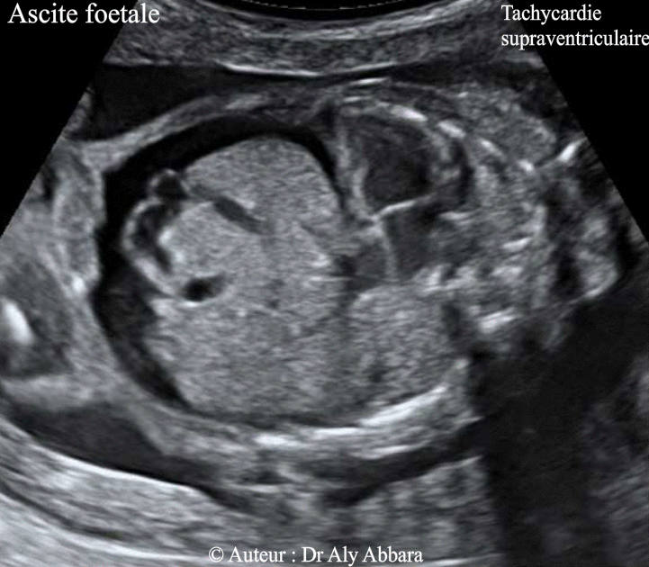 Ascite dans un contexte de tachycardie supra-ventriculaire chez un foetus de 23 SA