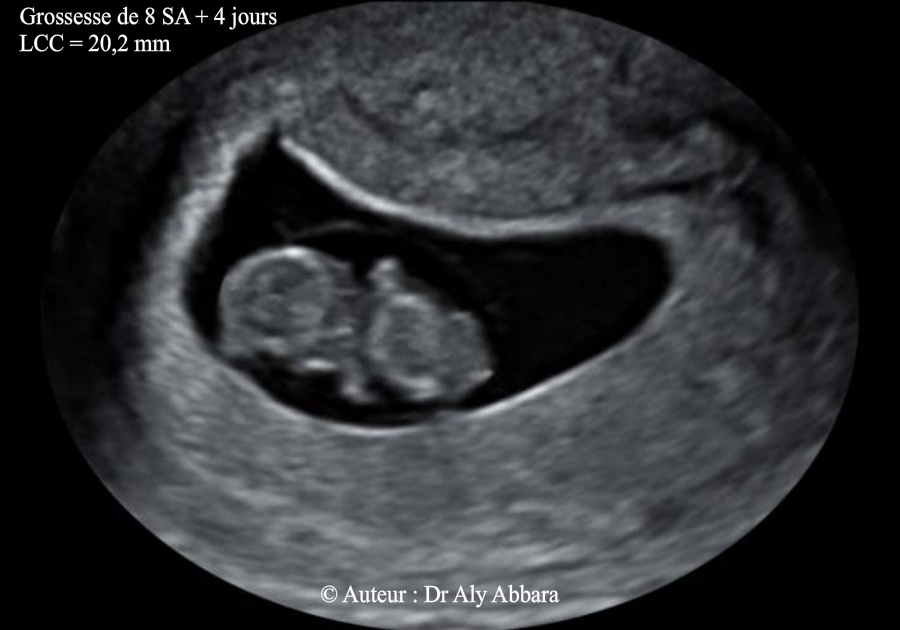 Grossesse de 8 SA et 4 jours - Anatomie échographique