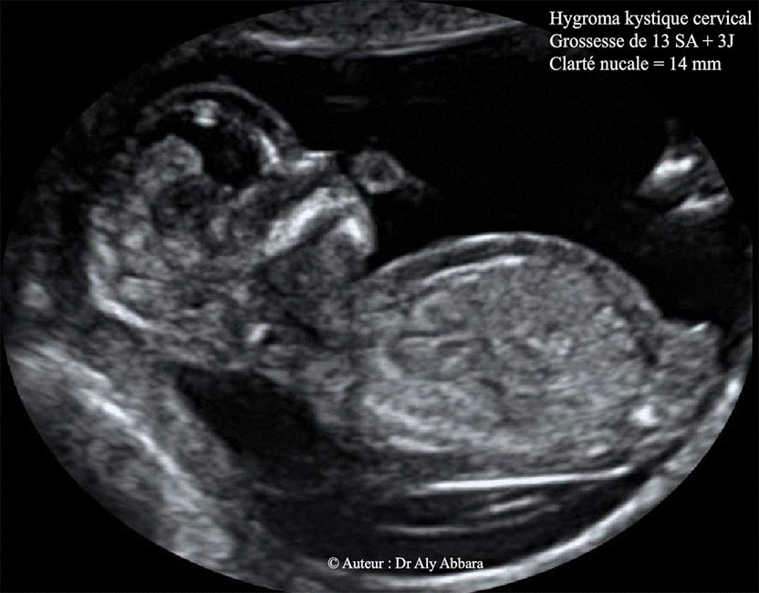 Hygrpma cervical kystique - Foetus âgé de 13 SA et 4 jours - Donnée échographiques