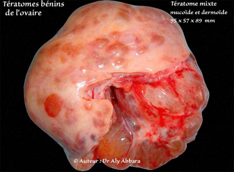 Kyste de l'ovaire complexe, mucineux et dermoïde, bénin - Images cliniques