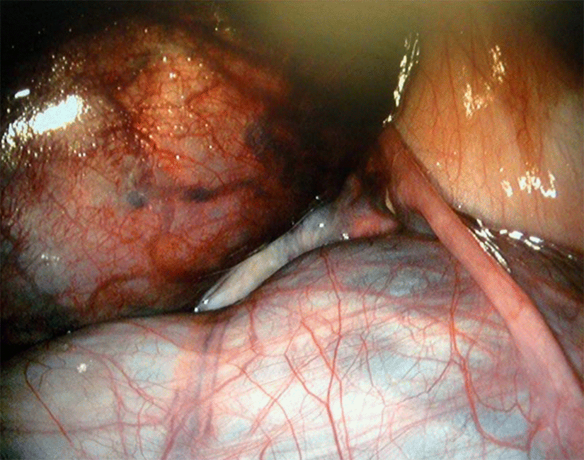 Kyste para-ovarien droit chez une femme enceinte de 17 SA - Images cliniques