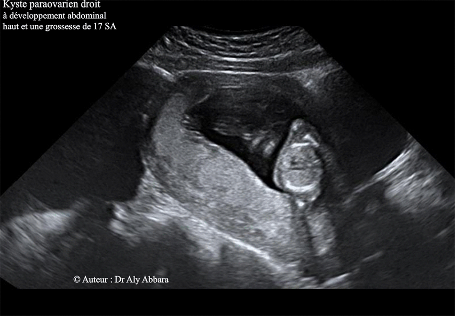 Kyste para-ovarien chez une femme enceinte de 17 SA - Images échographiques