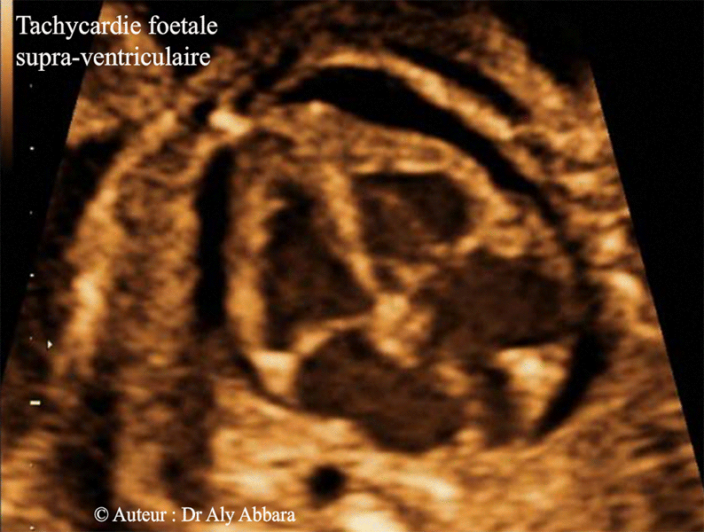 Tachycardie compliquée d'un épenchement péricardique faisant partie d'une anasarque foetoplacentaire - Grossesse de 23 SA