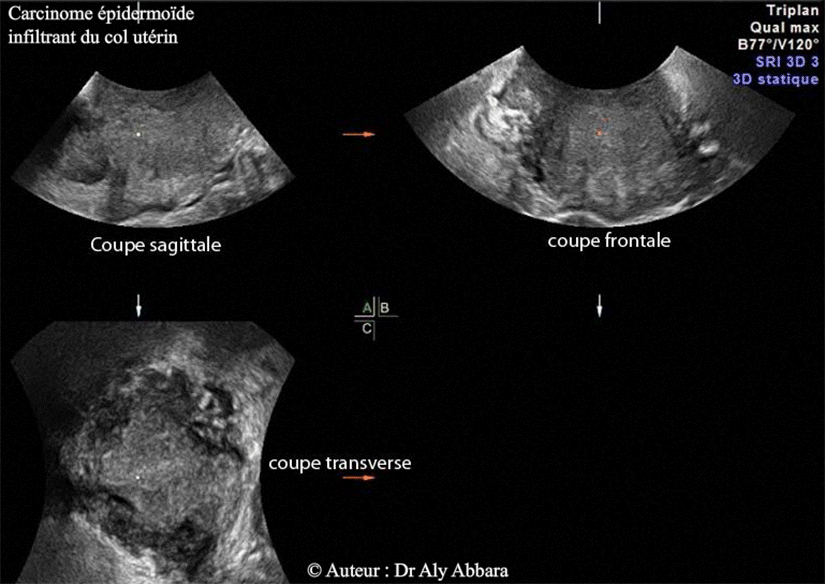 Carcinome épidermoïde du col de l'utérus - Images en 3D - triplan