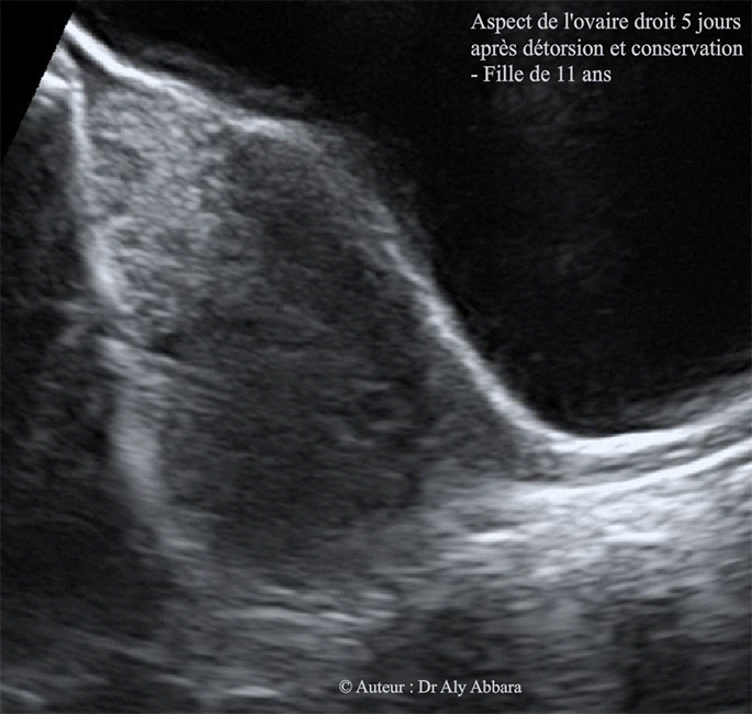 Torsion des annexes droites chez une fille de 11 ans - Aspect échographique de l'ovaire droit 5 jours après la détorsion chirurgicale