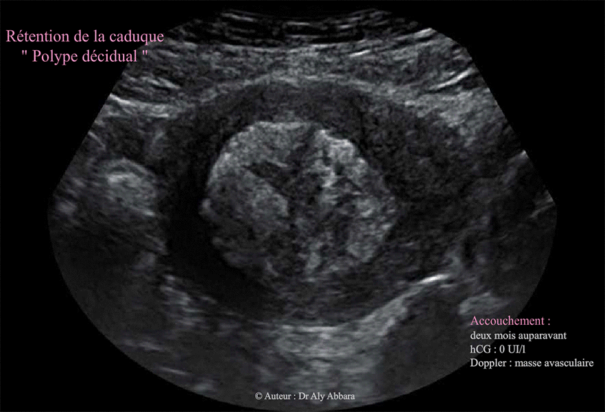 Polype décidual en post-partum ou rétention de la caduque endmétriale en post-partum (accouchement deux mois auparavant