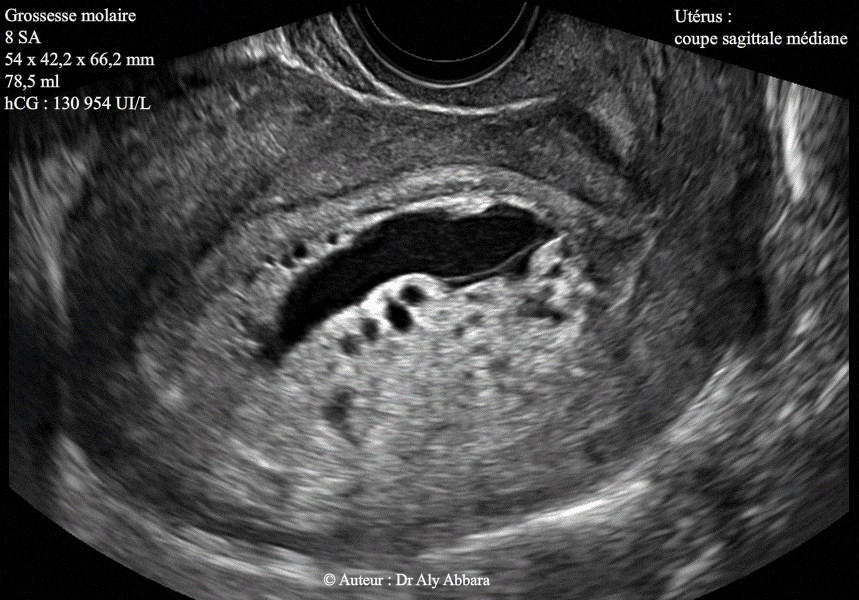 Grossesse môlaire complète caractérisée par la présence d'un sac amniotique sans embryon et sans sac vitellin