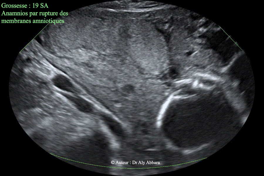 Anamnios par rupture prématurée des membranes à 19 SA - Aspect du placenta