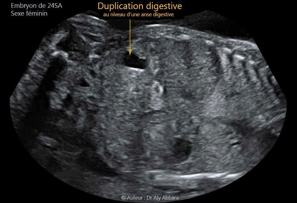 Images échographiques de duplication digestive intestinale chez un foetus agé de 24 SA