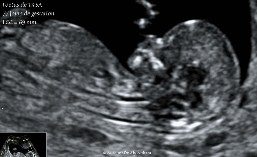 Embryon âgé de 53 jours de gestation (9 SA + 4 jours) - Composantes anatomiques - مضغة بعمر 53 يوماً - العناصر التشريحية الجنينية