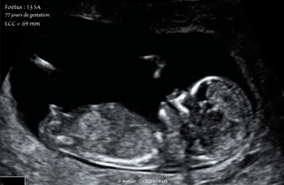 Embryon âgé de 53 jours de gestation (9 SA + 4 jours) - Composantes anatomiques - مضغة بعمر 53 يوماً - العناصر التشريحية الجنينية