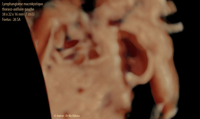 Lymphangiome macrokystique thoraco-axillaire gauche - Grossesse de 26 SA - Image échographique en 3D