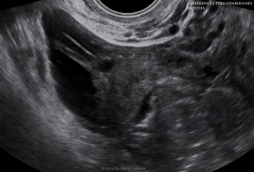 Adhérences péri-ovariennes droites (brides et voiles) fixant l'ovaire à la paroi latérale du pelvis - images échographiques