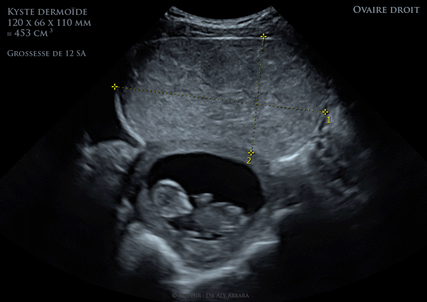 Ovaire droit - Volumineux tératome bénin(kyste dermoïde) chez une femme enceinte de 12 SA - Échographie