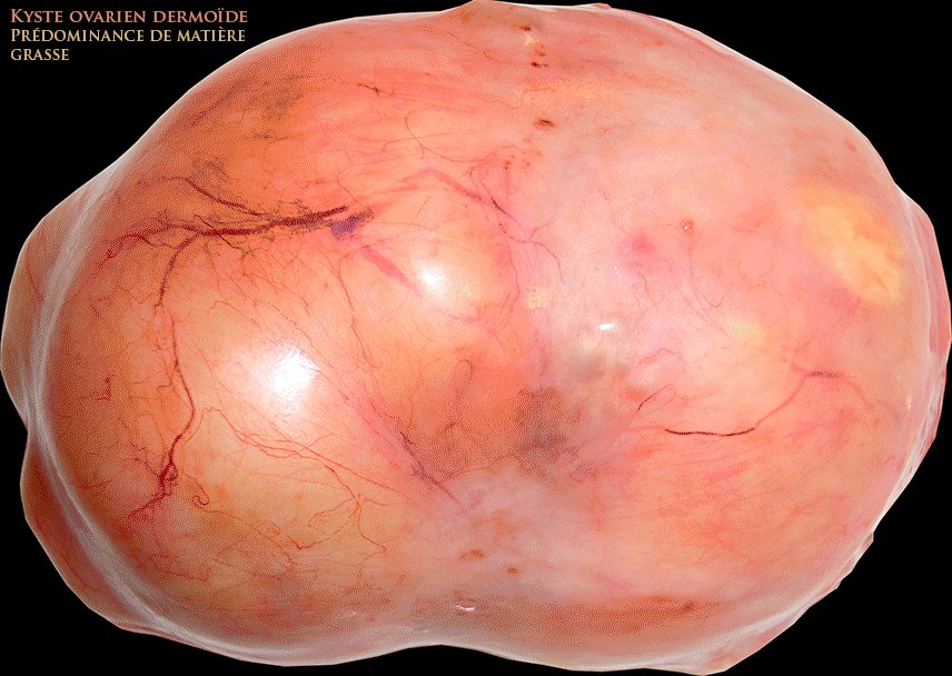 Ovaire droit - Volumineux tératomes bénins(kyste dermoïde) chez une femme enceinte de 12 SA - Échographie et images cliniques