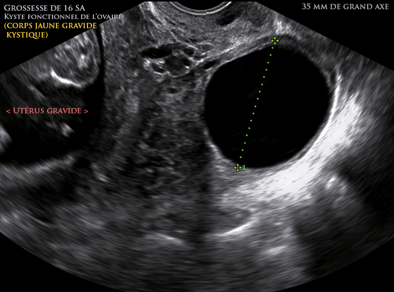 Kyste ovarien fonctionnel de type de corps jaune gravide kystique de 35 mm de grand axe, chez femme enceinte de 16 SA