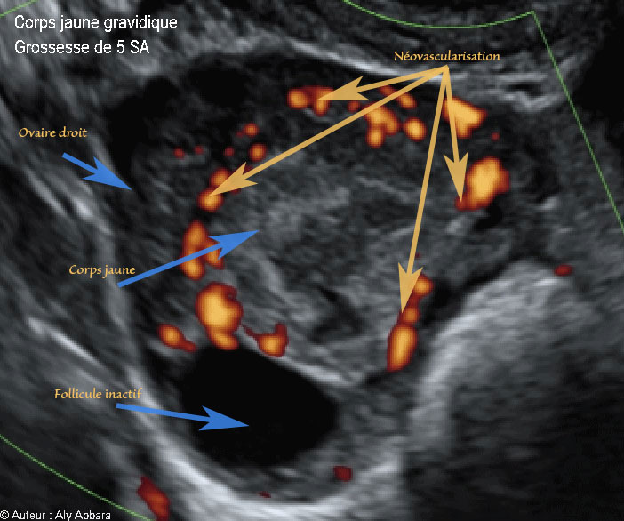 Corps jaune gravidique dans l'ovaire droit - Doppler Energie - جسم أصفر حملي في المبيض الأيمن -  5 SA