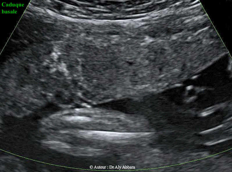Placenta à 28 SA - L'aspect de la caduque à  l"échographie 2D et au Doppler Flow- Dynamic
