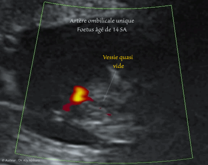 Artère ombilicale unique - grossesse de 33 SA - Absence de d'anomalie associée