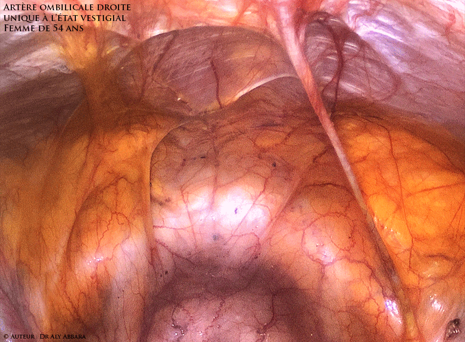 L'artère ombilicale unique (AOU) droite à l'état vestigial chez une patiente âgée de 54 ans - image clinique animée