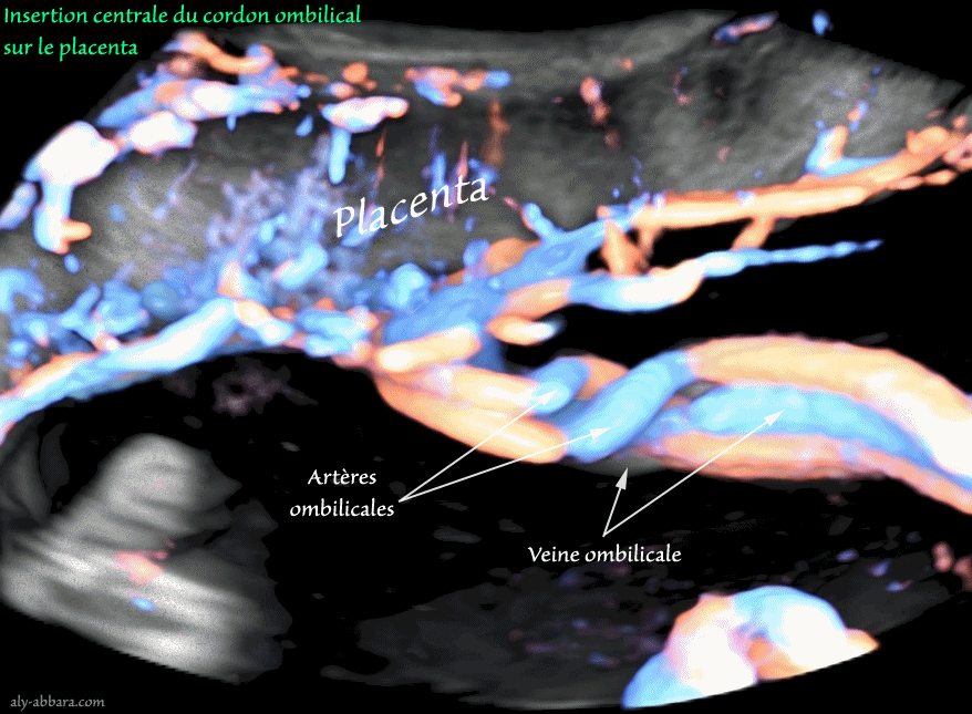 Cordon ombilical normal - Doppler couleur volumique
