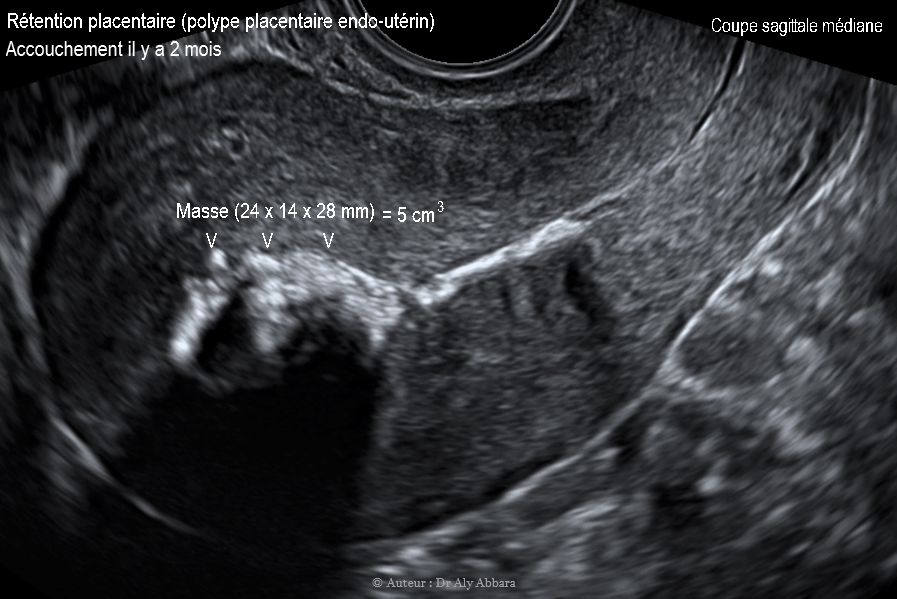 Polype placentaire ou rétention patielle d'un segment du placenta chez patiente ayant accouché par voie naturelle il y a deux mois