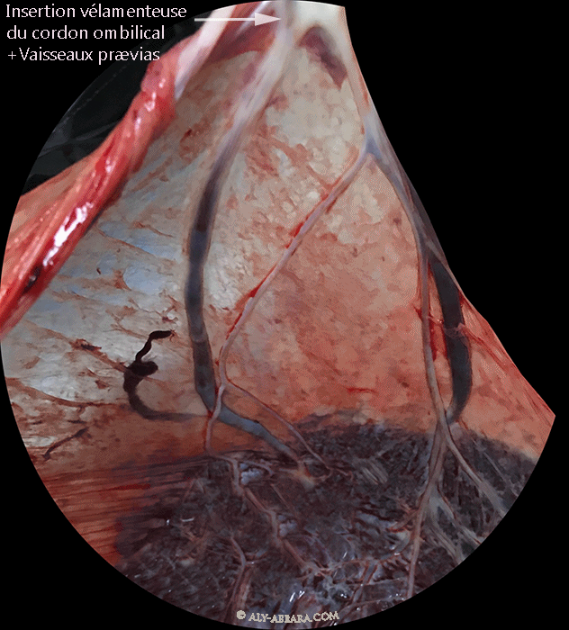 Placenta d'une grossesse de 36 SA et 3 jours caractérisé par l'insertion vélamenteuse du cordons ombilical ; les vaisseaux sanguins reliant le cordon au placenta sont praevia et traversant l'orifice interne du col utérin
