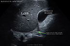Agénésie du rein droit associée à une malformation utérine de type d'utérus bicorne unicervical - Fichier animé type vidéo MP4 et GIF