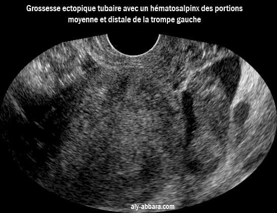 Image échographique montrant un hématosalpinx des portions moyenne et distale de la trompe gauche, formé au cours de l'évolution d'une grossesse ectopique tubaire
