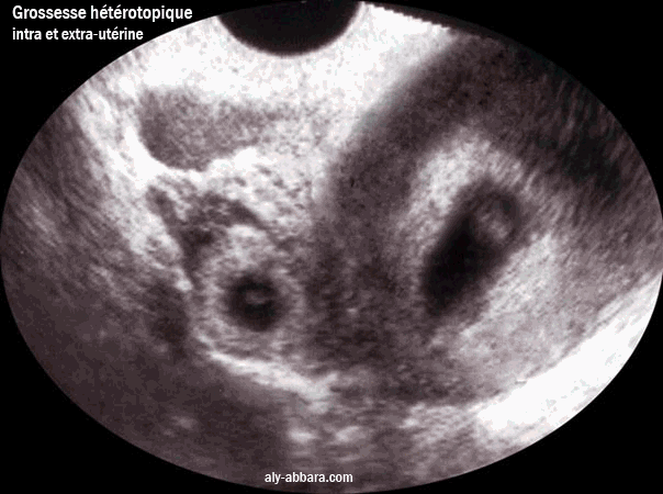 Grossesse hétérotropique ou ditropique associant une grossesse intra-utérine évolutive et une grossesse extra-utérine non évolutive insérée sur le moignon restant de la trompe droite