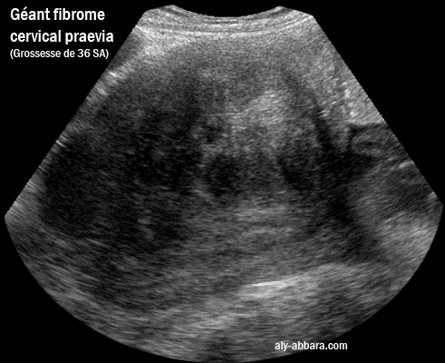 Géant fibrome cervical praevia chez femme enceinte, une primipare à 36 SA