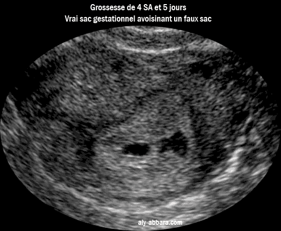 Image échographique montrant une grossesse débutant intra-utérine de 4 semaines d'aménorrhée et 5 jours avec la visualisation d'un vrai sac gestationnel avoisinant un faux sac