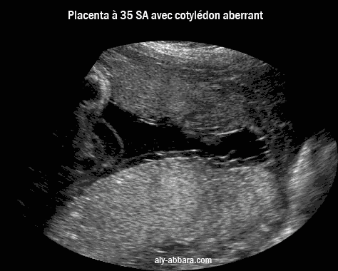 image échographique montrant un placenta à 35 SA avec un cotylédon aberrant ; on individualise au Doppler, Dynamic Flow, les vaisseaux sanguins reliant le cotylédon au placenta