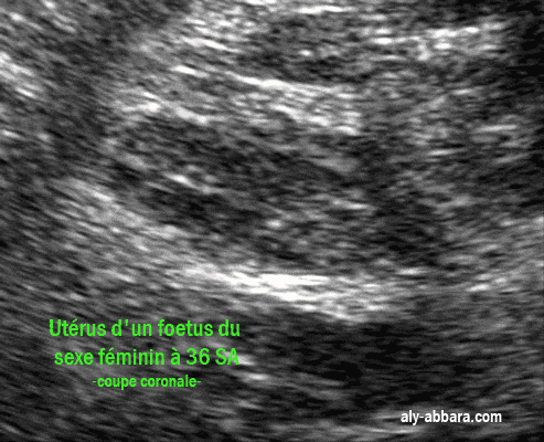 Une coupe échographique coronale de l'utérus d'un foetus du sexe féminin à 36 semaines d'aménorrhée
