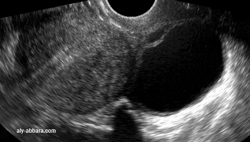 Kyste ovarien gauche  fonctionnel  qui est apparu  5 mois après la pose d'un stérilet hormonal, il s'agit d'un kyste de 50 mm de grand axe