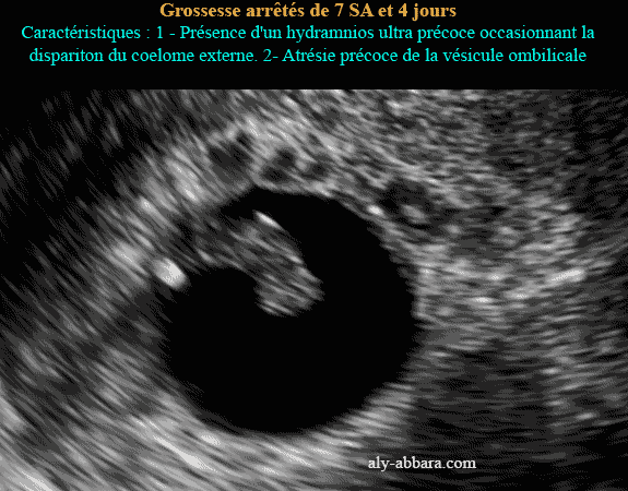 Image échographique montrant une grossesse arrêtée à 7 SA et 4 jours, caractérisée par l'extension du sac amniotique par un hydramnios ultra-précoce occassionnant la disparition du coelome externe et l'atrésie précoce du sac vitellin secondaire